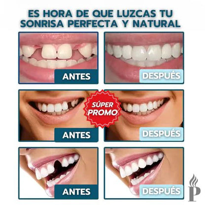 Carillas Dentales Adaptables🦷